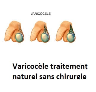 Varicocèle traitement naturel sans chirurgie