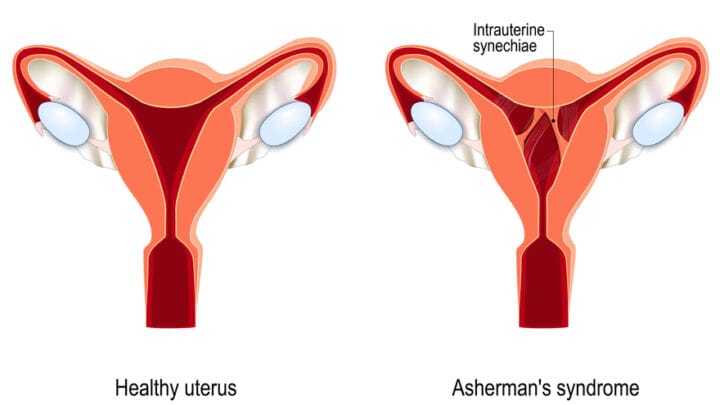 Traitement Naturel des Synéchies Utérines