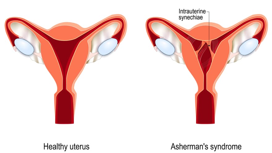 Traitement Naturel des Synéchies Utérines