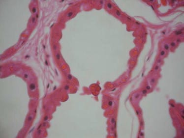 Maladie de Lafora Traitement Naturel: