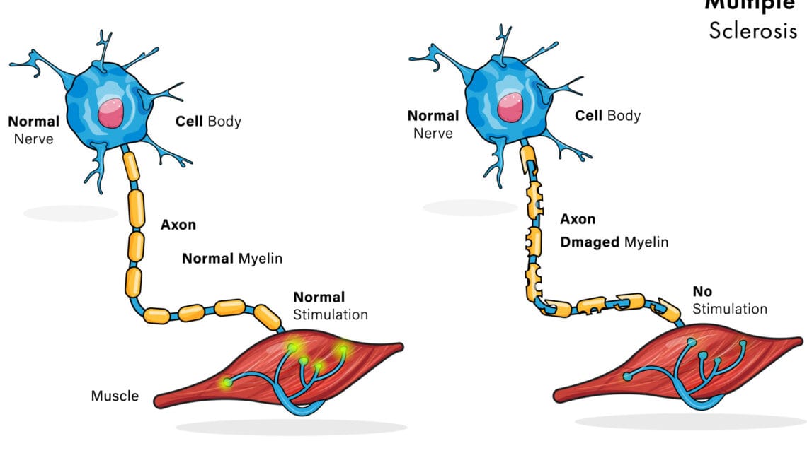 Sclérose en Plaques Solutions Naturelles