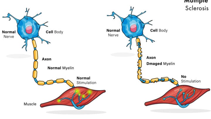 Sclérose en Plaques Solutions Naturelles