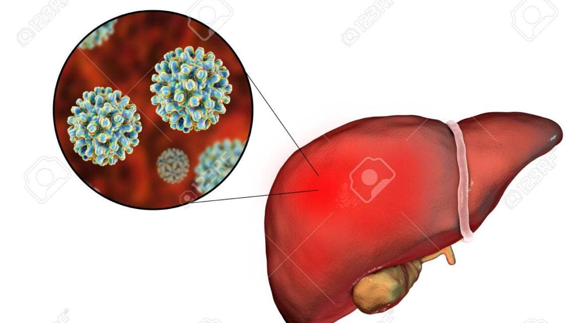 Infection Virale de L'hépatite B