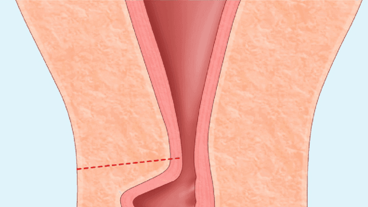 Isthmocèle et Infertilité