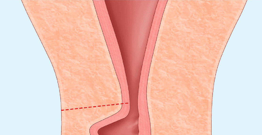 Isthmocèle et Infertilité