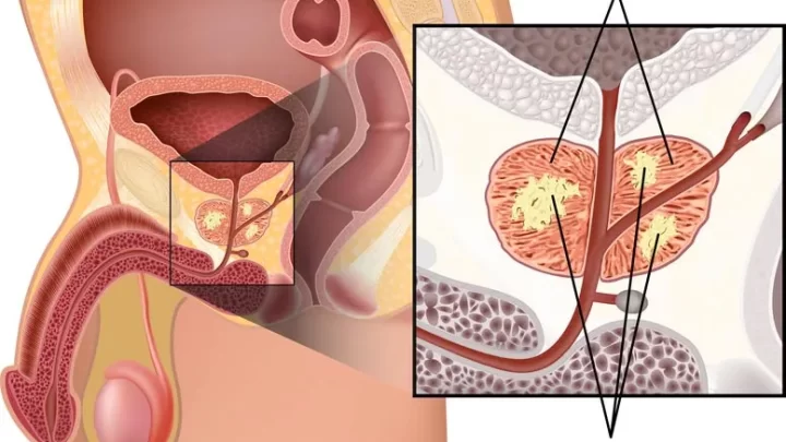 Cancer de la Prostate Solution Naturelle