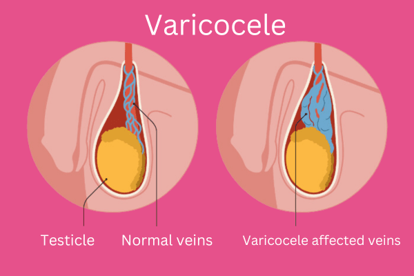 Varicocèle Solutions Naturelles