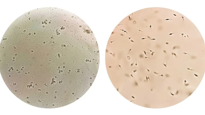 Traitement Naturel de l'Azoospermie Excrétoire