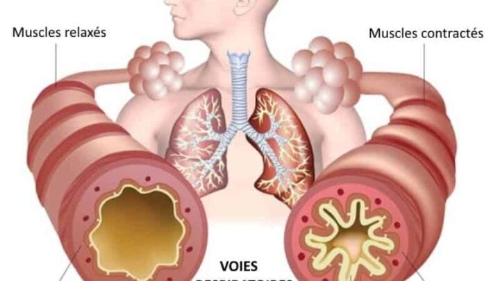 Asthme Plantes et Solutions Naturelles