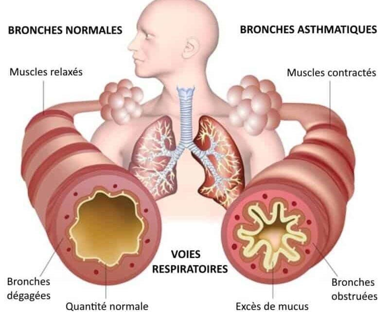Asthme Plantes et Solutions Naturelles