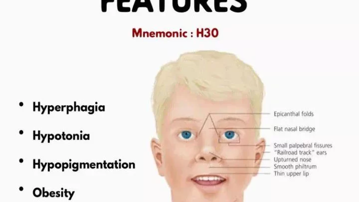 Syndrome de Prader-Willi