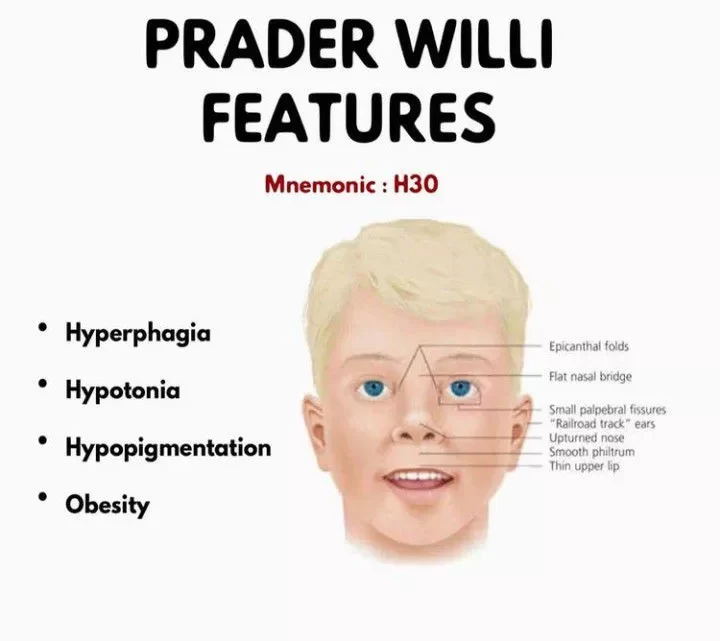Syndrome de Prader-Willi