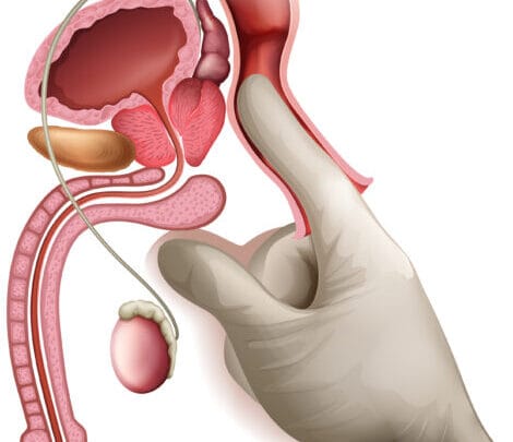 Épilobe et Prostate