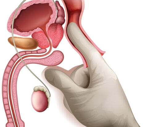 Épilobe et Prostate