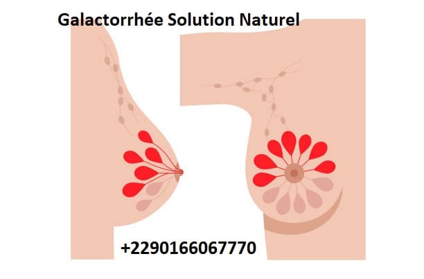 Galactorrhée Solution Naturel