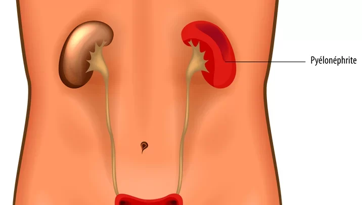 Infection Urinaire Solutions Naturelles