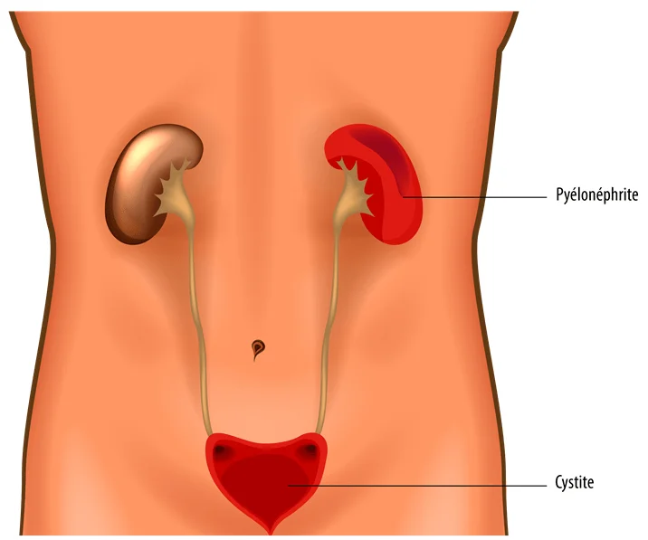 Infection Urinaire Solutions Naturelles