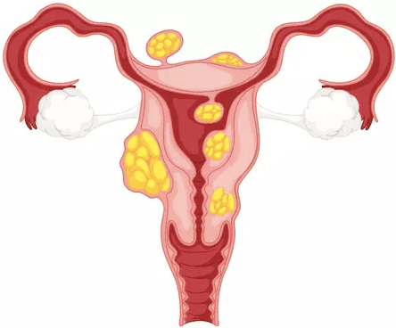 Traitement Naturel des Fibromes Utérins