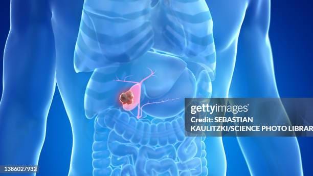 Traitement Naturel du Cancer de la Vésicule Biliaire