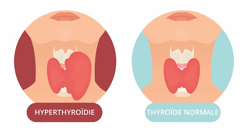 Traitement Naturel de l'Hyperthyroïdie