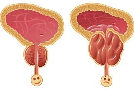 Cancer de la Prostate Solution Naturelle