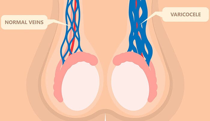 Soulager la Varicocèle naturellement