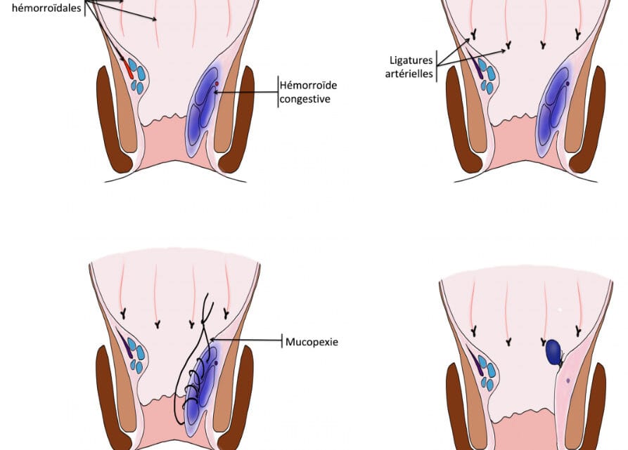 Finir naturellement avec l'hémorroïde