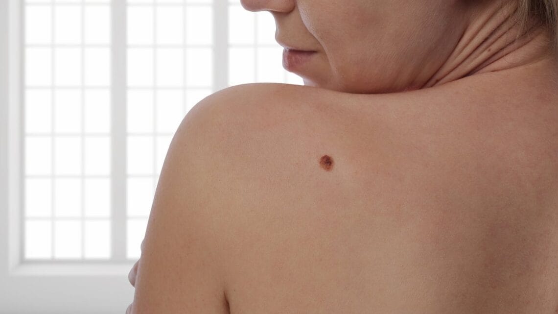 Mélanome Solution Naturelle