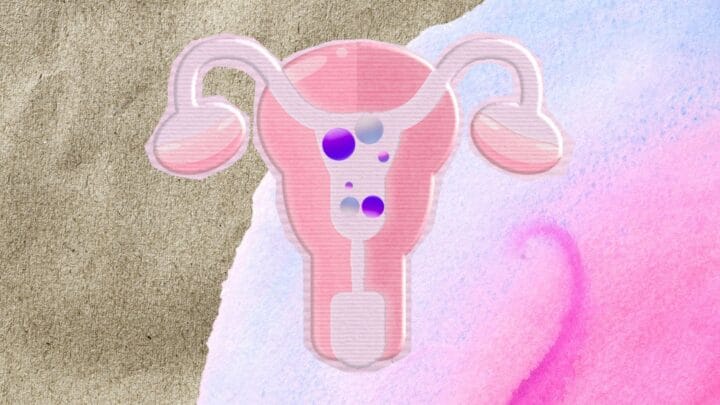 Traitement Naturel des Polypes Utérins