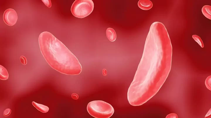 Drépanocytose SS Remède Naturel
