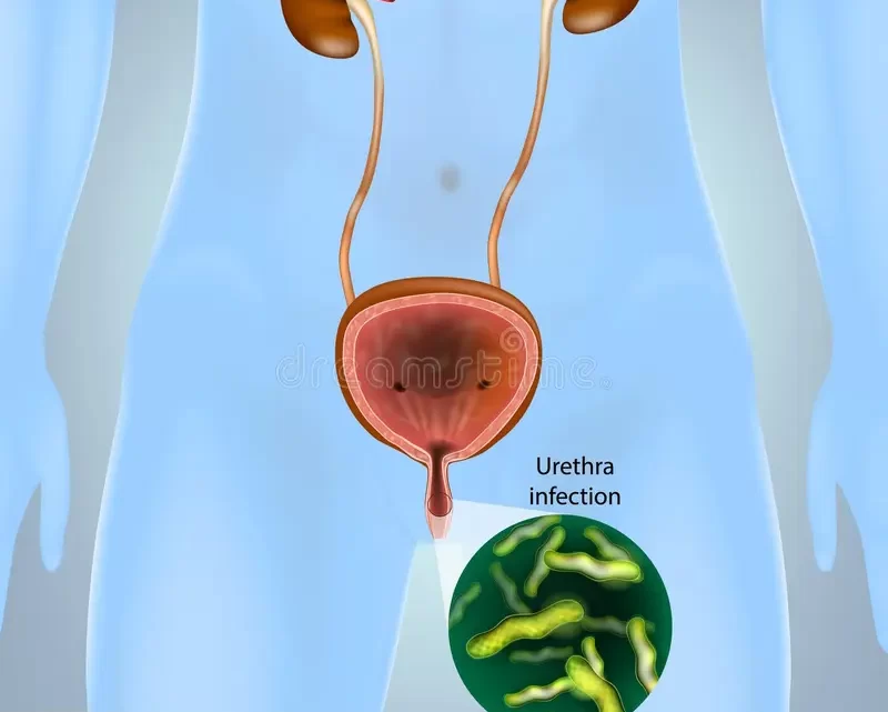 Cervicite et Urétrite Solutions Naturelles