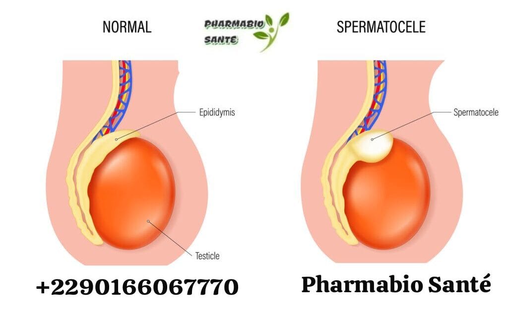 Spermatocèle Causes Solutions Naturelles