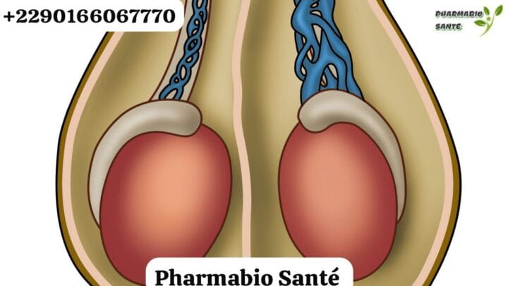 Varicocèle Chirurgie ou Embolisation