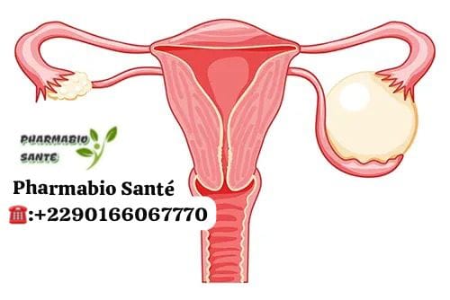 Traitement naturel kystes ovariens