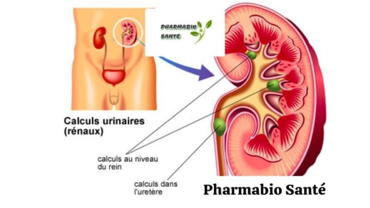 Dissoudre calculs urinaires naturellement