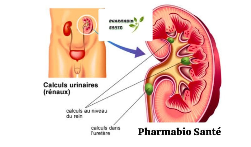 Dissoudre calculs urinaires naturellement