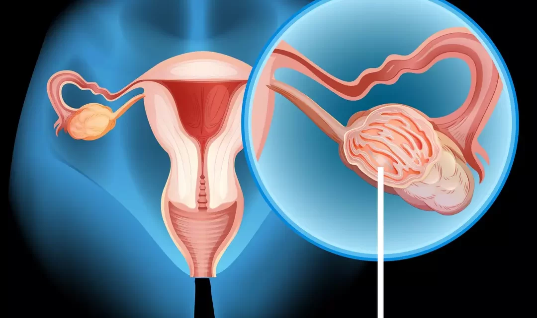 Traitement Naturel Salpingite