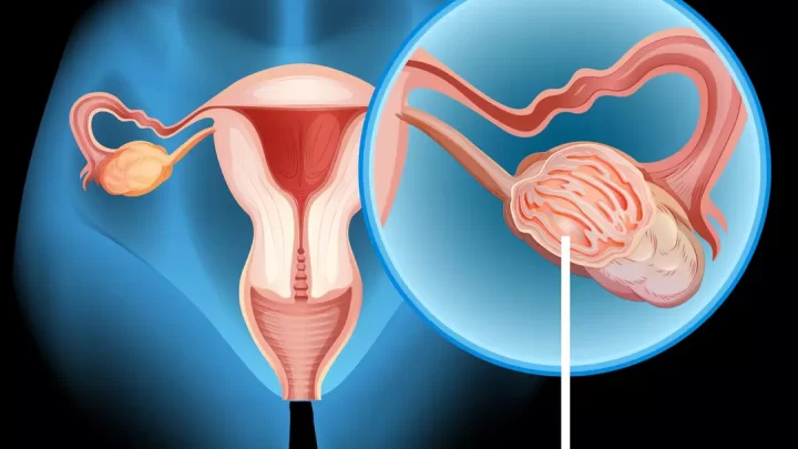 Traitement Naturel Salpingite