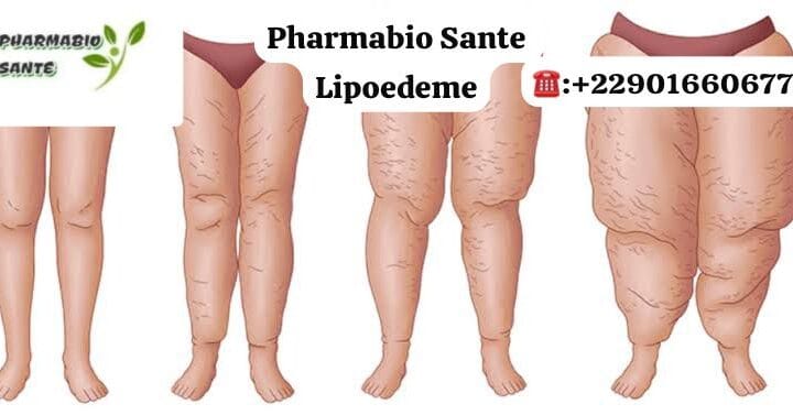 Lipoedème Solutions Naturelles