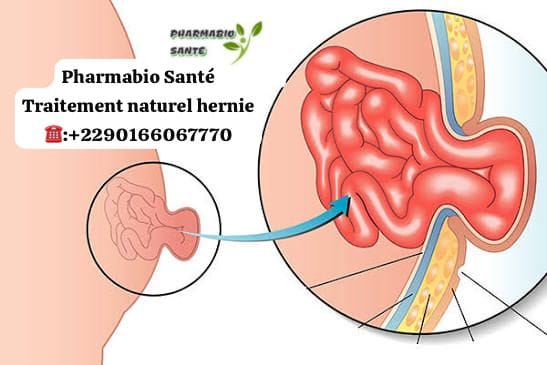 Traitement Naturel de la Hernie