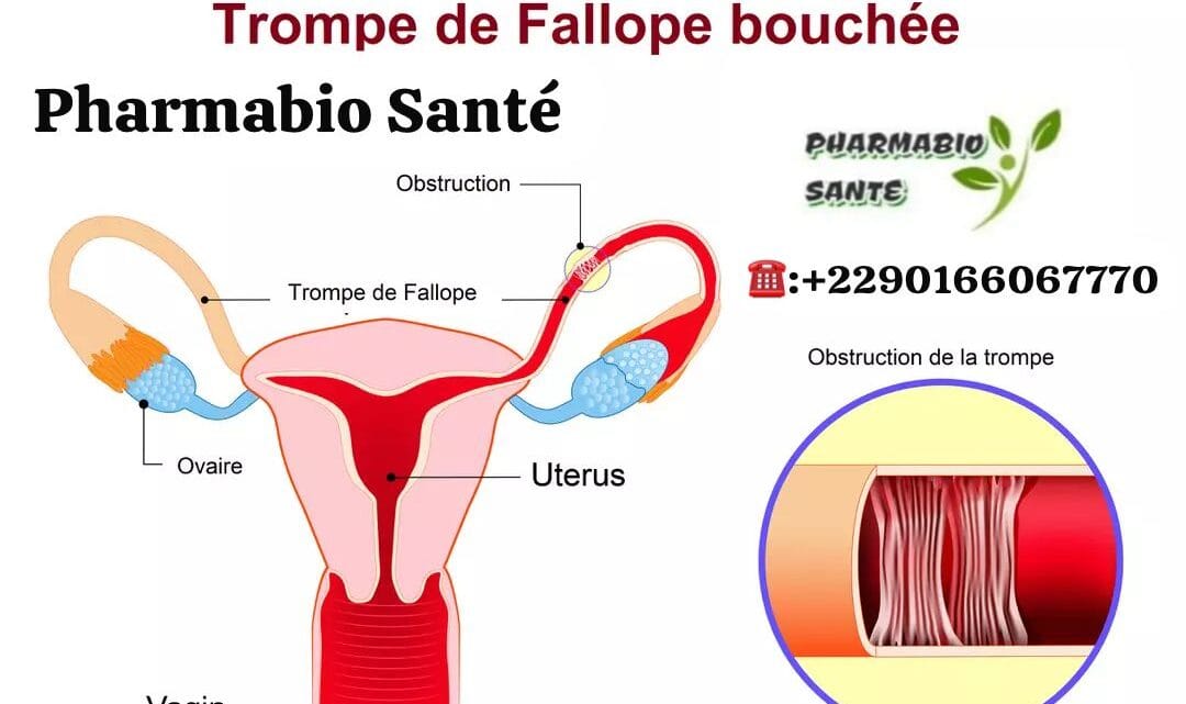 Déboucher les Trompes de Fallope Naturellement