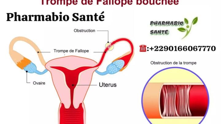 Déboucher les Trompes de Fallope Naturellement