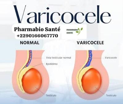 Varicocèle traitement naturel et alternatif
