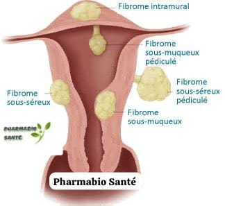 Assécher les Fibromes Myomes