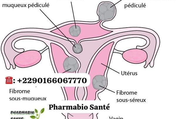 Fibromes Traitements Naturels