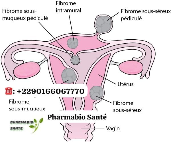Fibromes Traitements Naturels