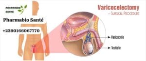 Varicocèle Nouveaux Solutions Naturelles