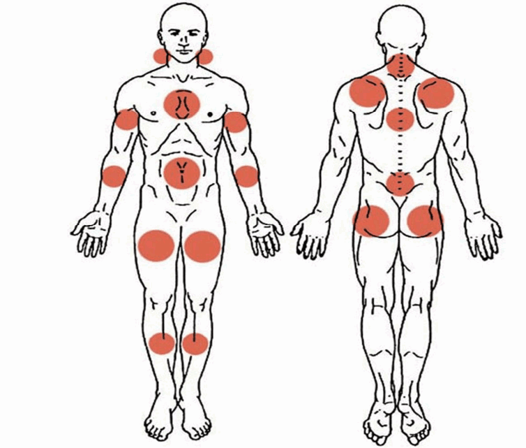 Fibromyalgie Solutions Naturelles