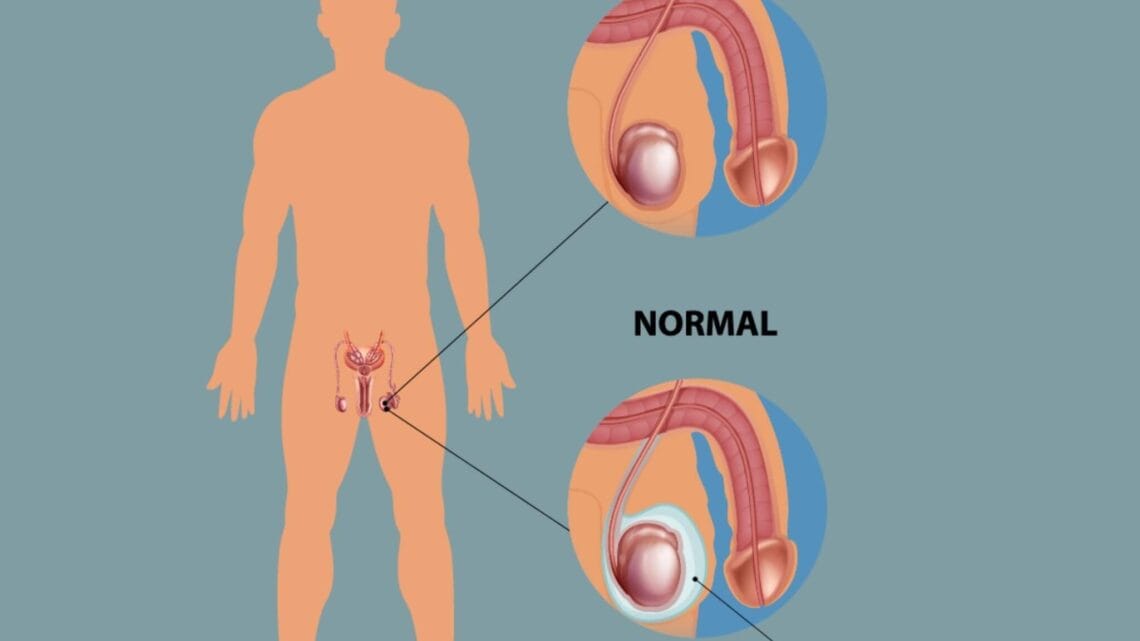Hydrocèle Traitements Naturels