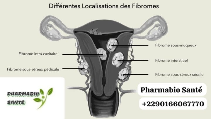 Fibrome Utérin Définition Symptômes